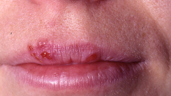 Suuhaava (huuliherpes)